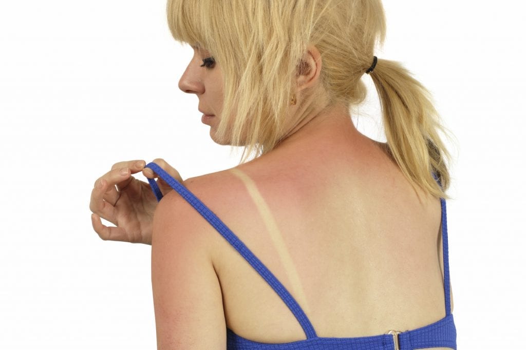 Summer Skin: Advice For Dealing With Sun Damaged Skin
