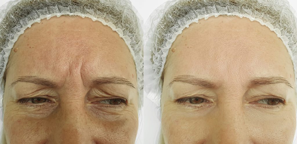 woman face wrinkles before and after treatment collage